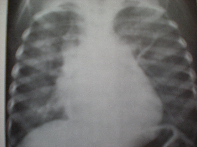 imagini edemul pulmonar